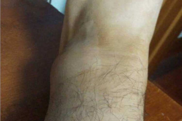 踝扭伤脚踝肿了的图 踝扭伤脚踝肿了的图