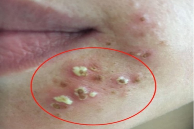 急性期口周湿疹口周脓包图 急性期口周湿疹口周脓包图