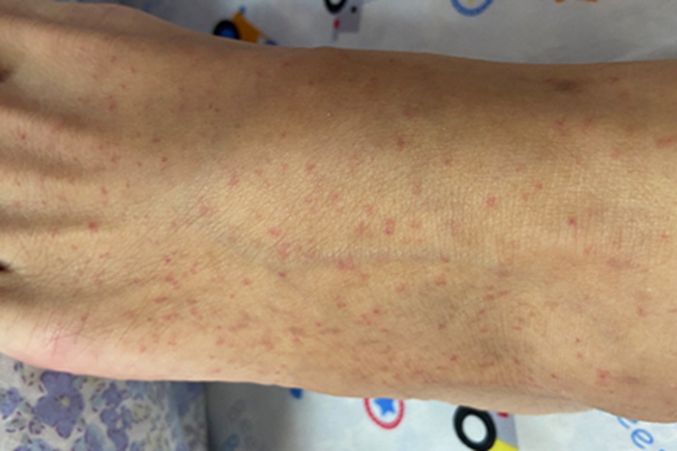 过敏性紫癜脚背血点图