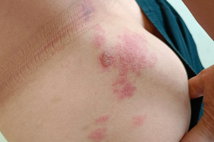 臀部轻度带状疱疹图