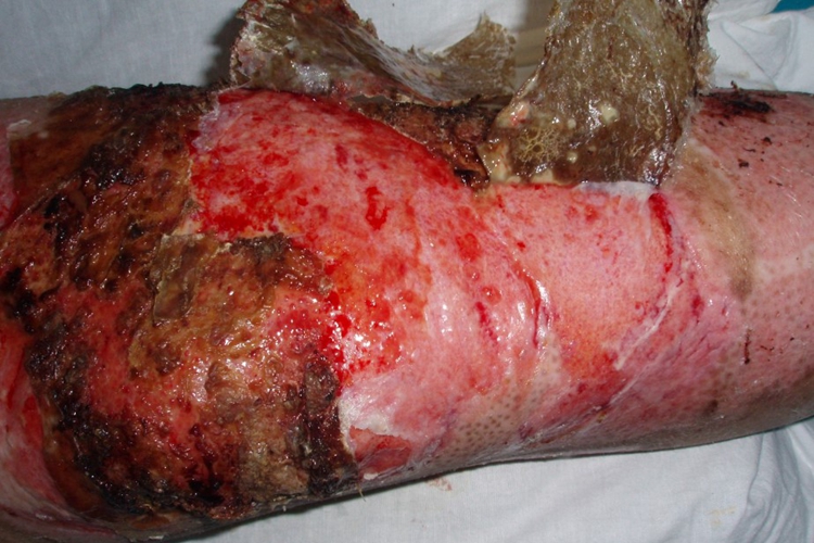 深Ⅱ度烧伤图 深Ⅱ度烧伤图