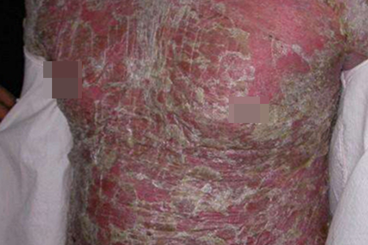 苔藓状淀粉样变胸部脱屑图 苔藓状淀粉样变胸部脱屑图