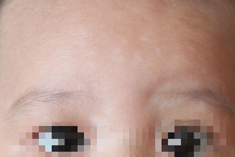 花斑糠疹额头上长白点点图