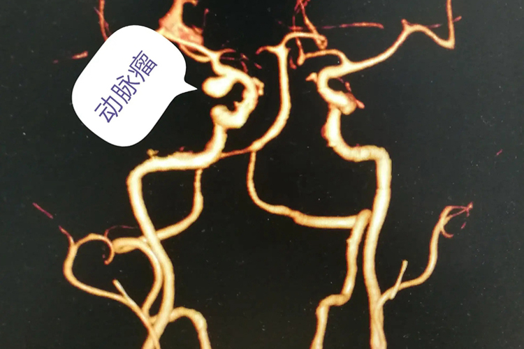 颅内动脉瘤图 颅内动脉瘤图