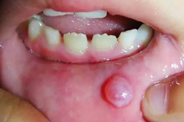 下唇黏液腺囊肿图