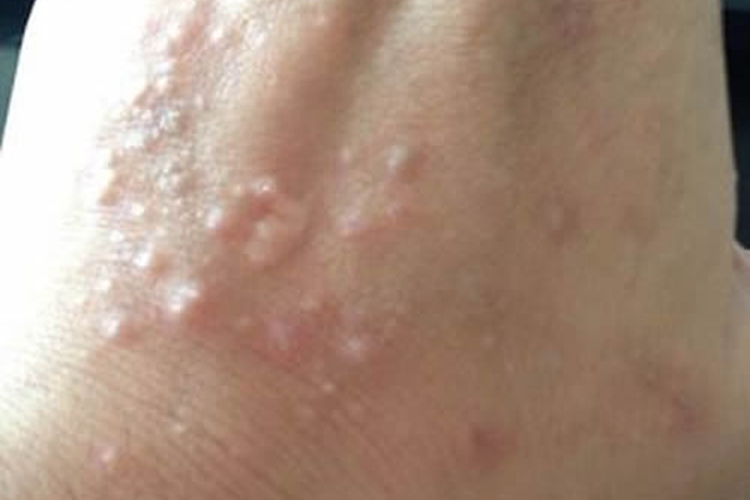 夏季皮炎手上出现红块图