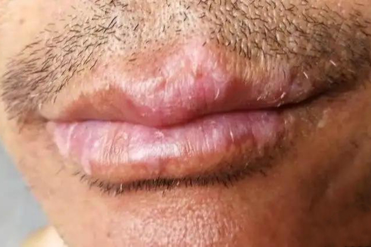 红斑狼疮早期10个征兆图片