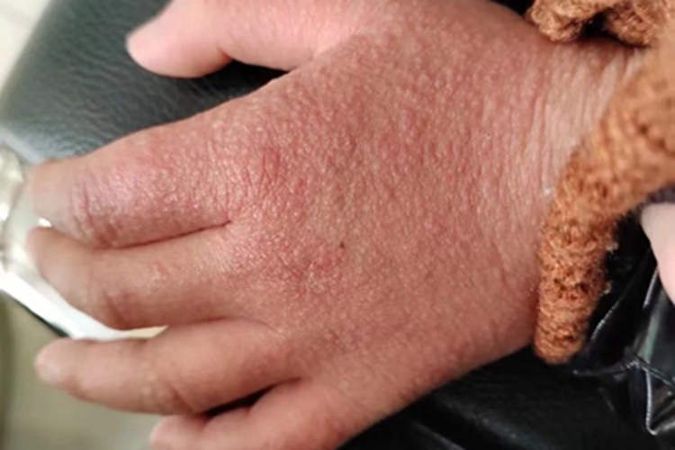 猩红热型药疹手部丘疹图