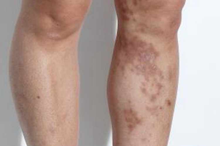 持久性色素异常性红斑脱屑图 持久性色素异常性红斑脱屑图