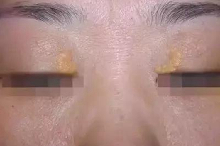 泛发性扁平黄色瘤眼睑小疙瘩图