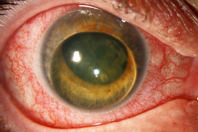 小孩晶状体挫伤图