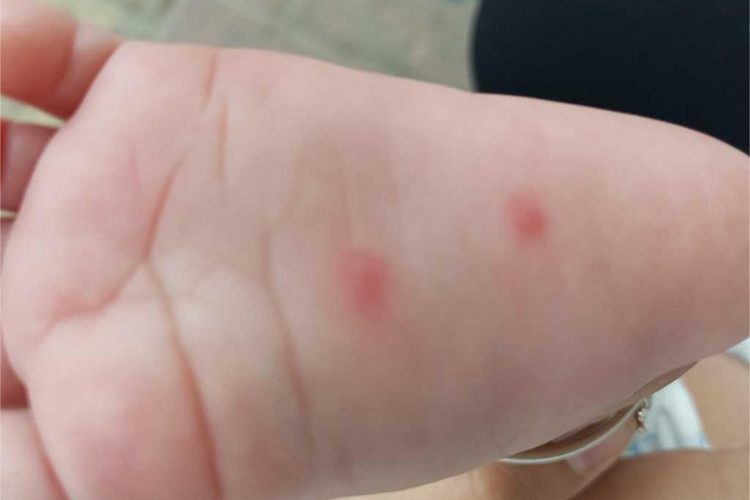 虫咬皮炎脚底丘疹图