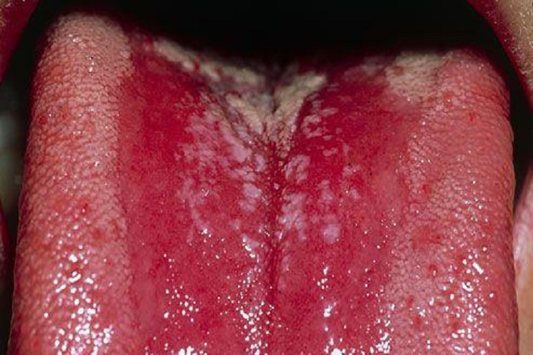 急性红斑型念珠菌性口炎图