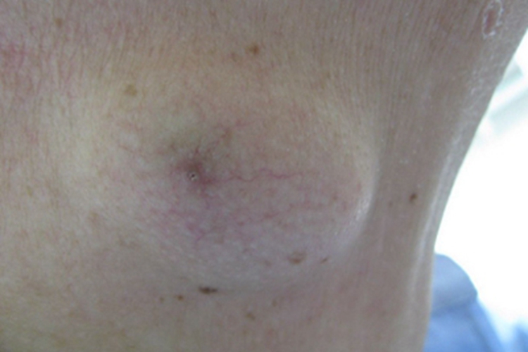 皮肤型组织胞浆菌病颈部症状图