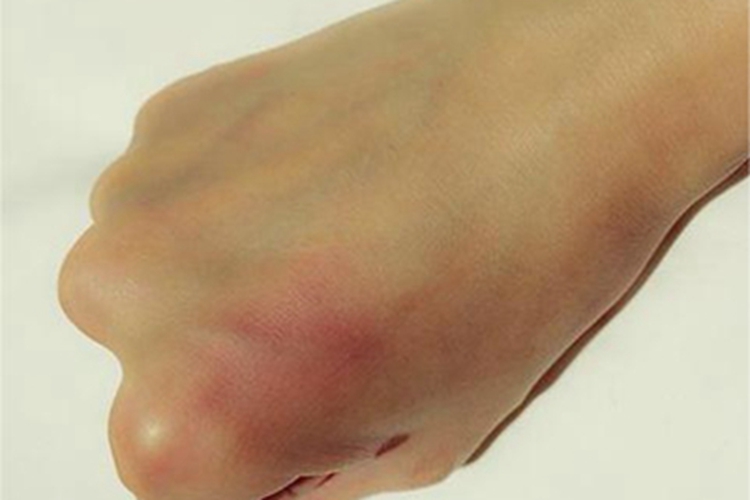 挫伤手背症状图