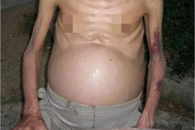 血吸虫病腹部明显肿大图