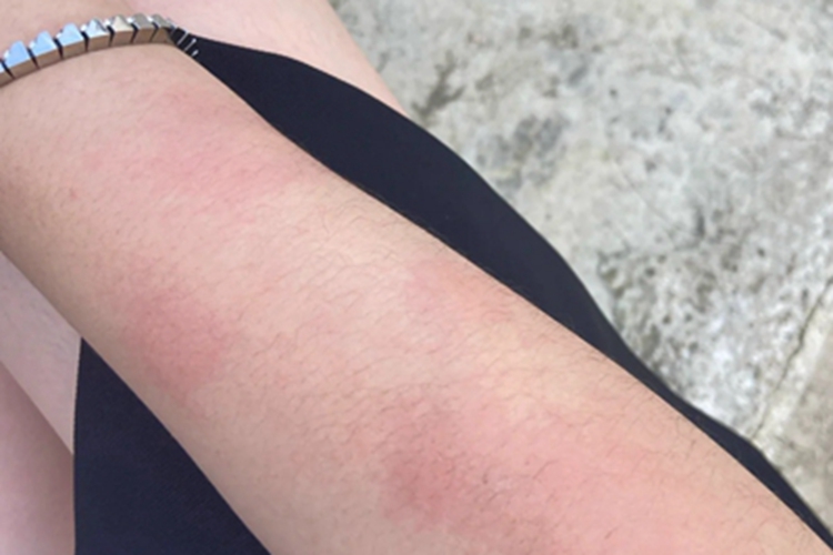 日照性皮炎胳膊有红斑图