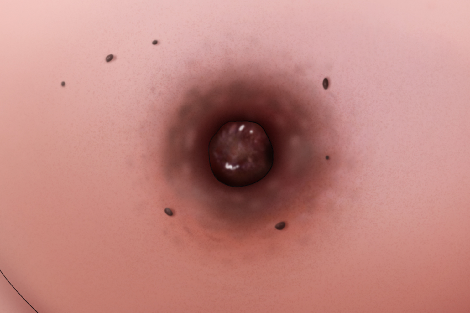 乳房周围的褐色疣图