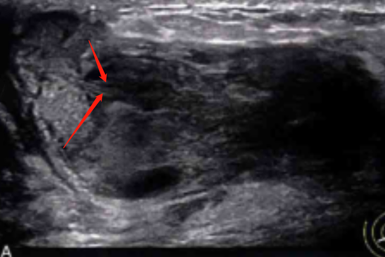 乳腺导管扩张Ⅱ型超声图