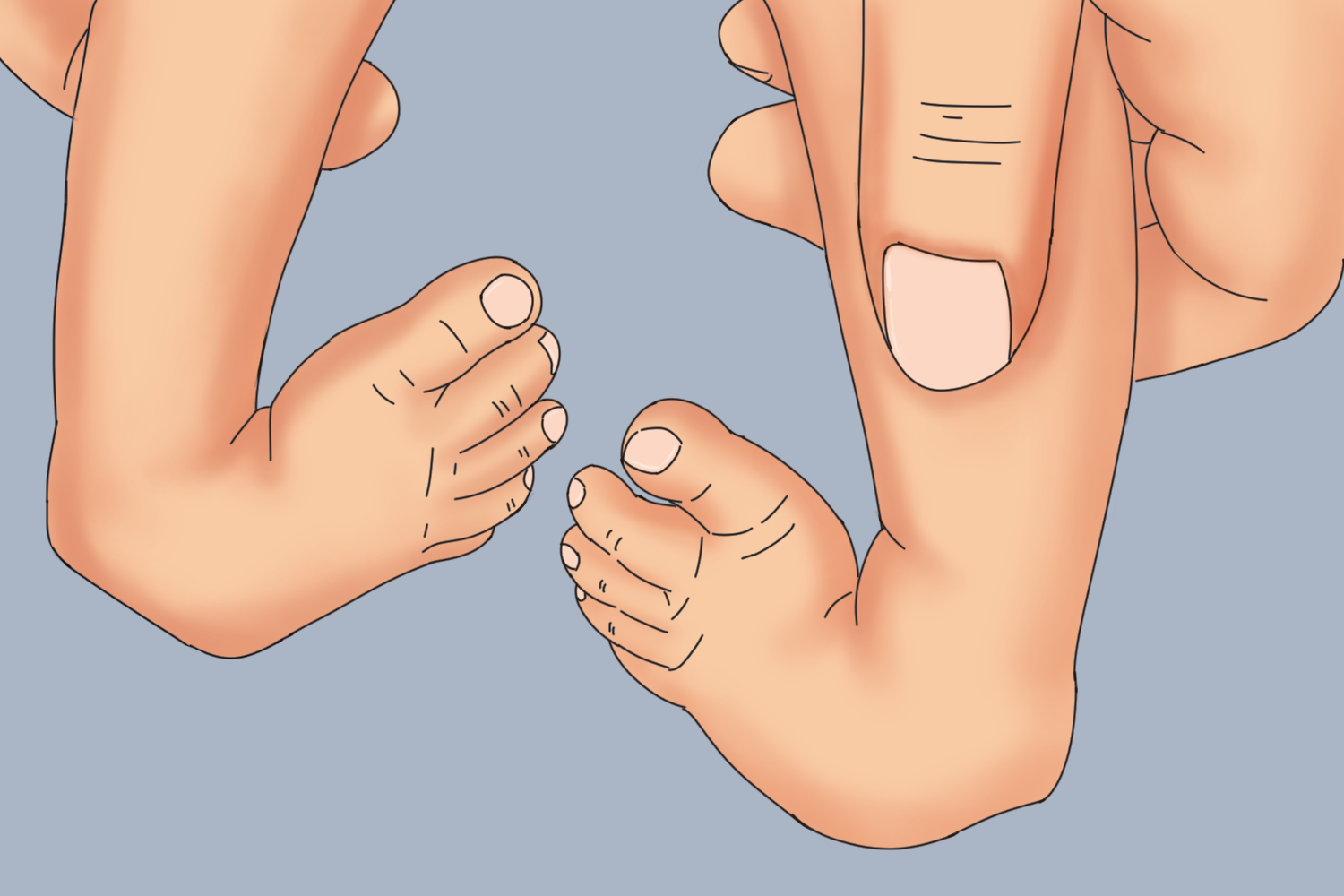 宝宝双足内翻图 宝宝双足内翻图