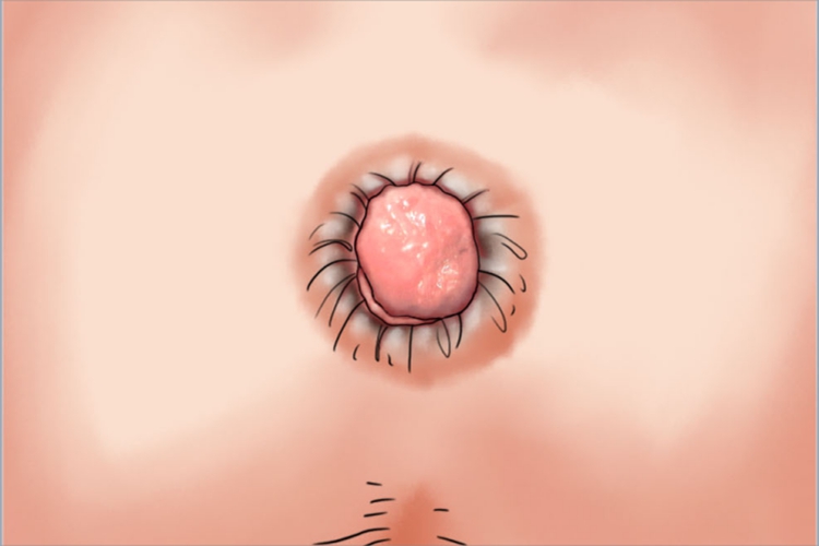 Ⅲ度内痔肛门症状手绘图