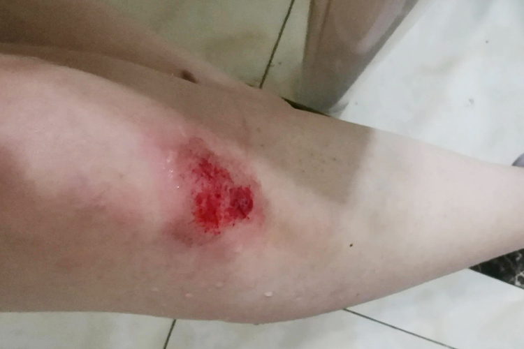 擦伤开放性创口图 擦伤开放性创口图