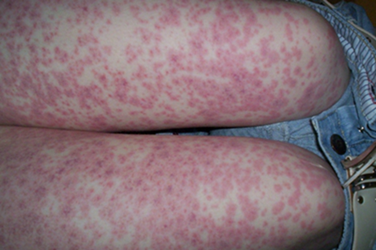 单纯性紫癜大腿症状图 单纯性紫癜大腿症状图
