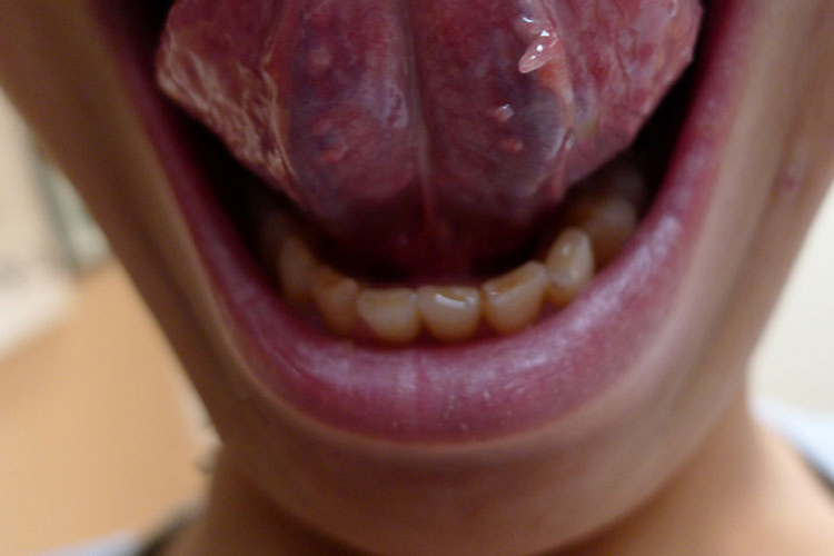 舌部感染HPV锥形疣图 舌部感染HPV锥形疣图