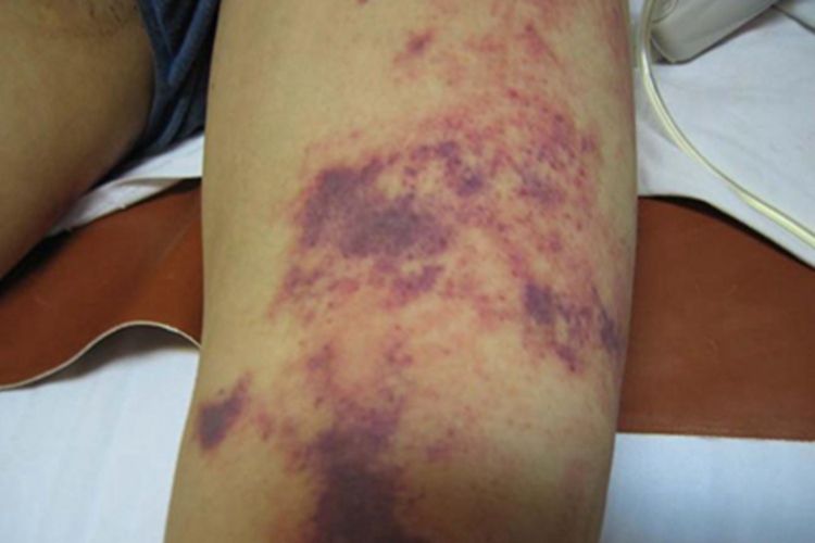 血友病大腿症状图