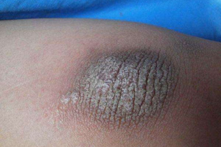 摩擦黑变病肘部皮肤粗糙图