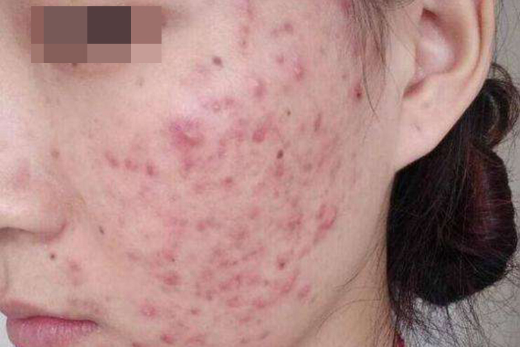 螨虫皮炎图 螨虫皮炎图