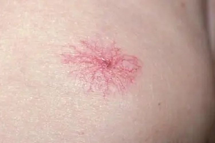 蜘蛛网状红血丝图