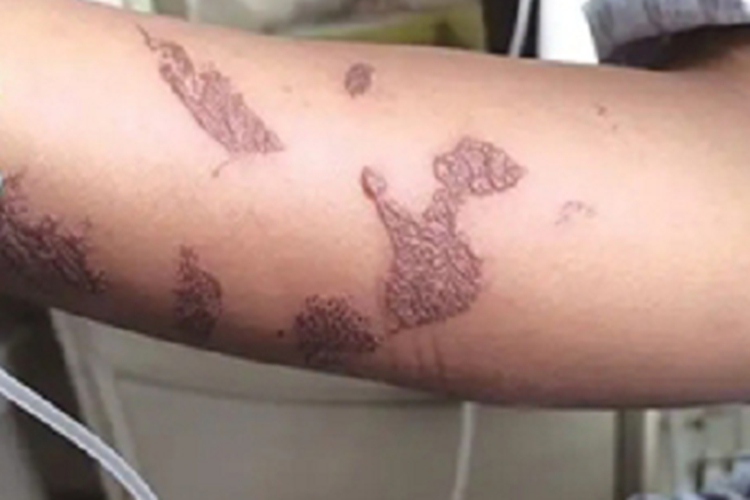 刺胞皮炎胳膊红斑图 刺胞皮炎胳膊红斑图