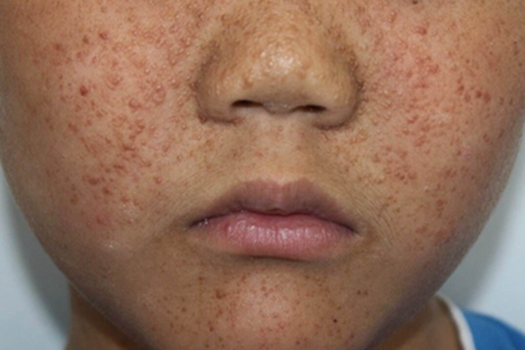 结节性硬化症症状图 结节性硬化症症状图