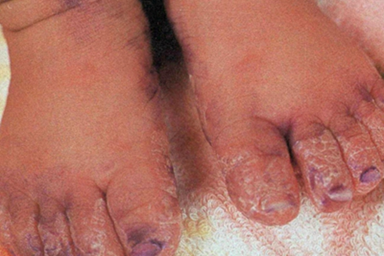 先天性梅毒脚部症状图