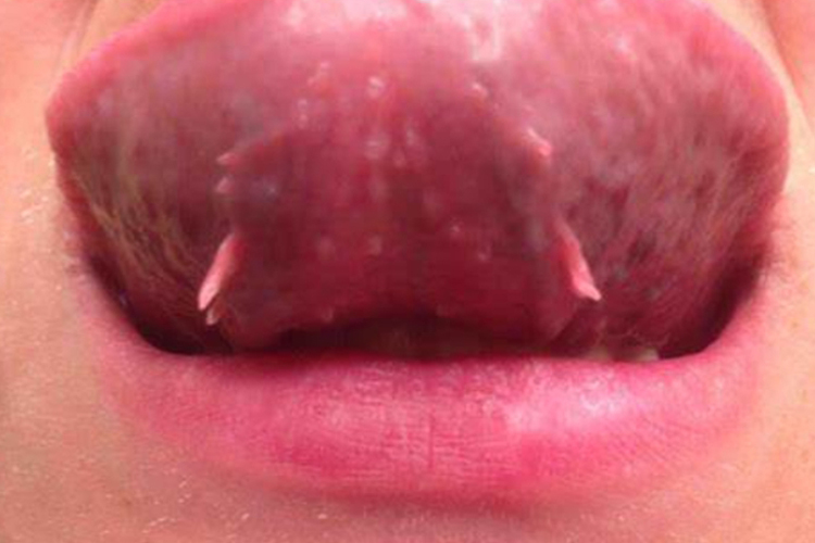 舌头丝状尖锐湿疣图