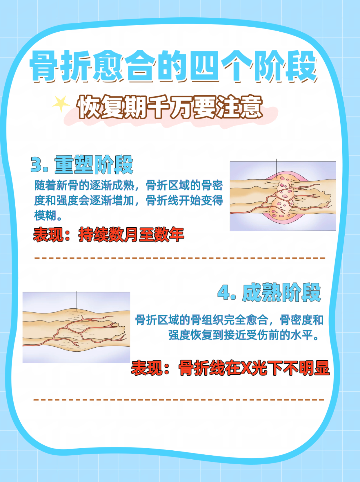 骨折愈合之旅：图解大全带你了解每一步