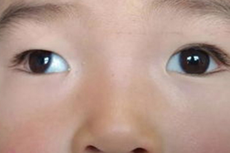 先天性共同性外斜视症状图 先天性共同性外斜视症状图