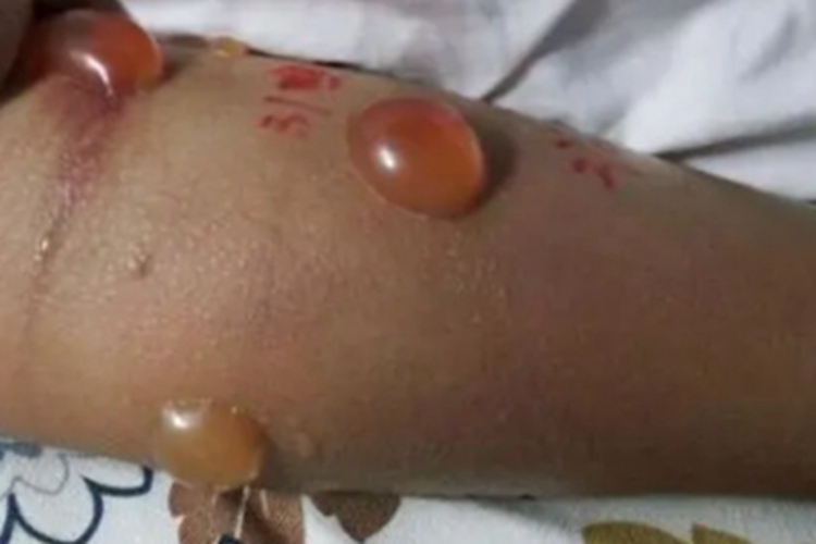 幼年型类天疱疮大水疱图