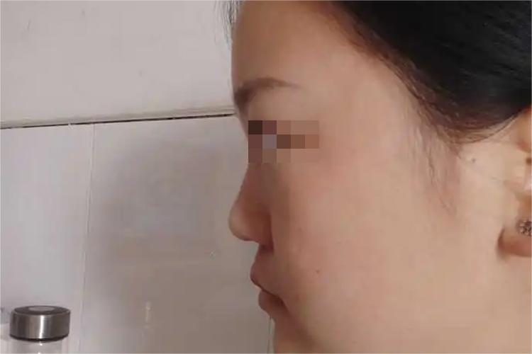 扁平脸侧面图