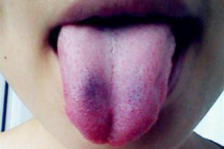 血瘀舌头图片比对图片