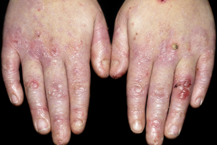 手浅表性大疱性脓皮病手部红肿图