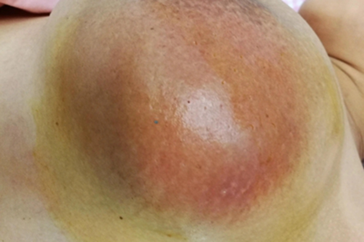 乳腺炎胸部肿块图 乳腺炎胸部肿块图