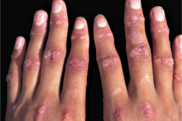 营养不良型大疱性表皮松解症图 营养不良型大疱性表皮松解症图