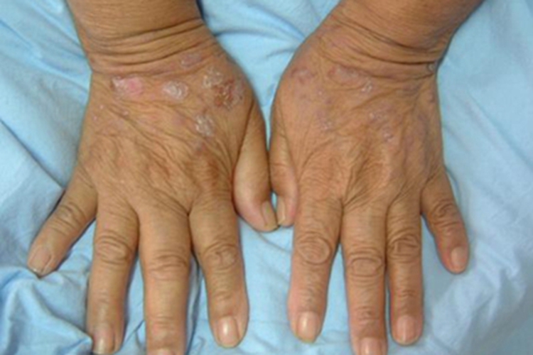 扁平苔藓样接触性皮炎手背症状图 扁平苔藓样接触性皮炎手背症状图