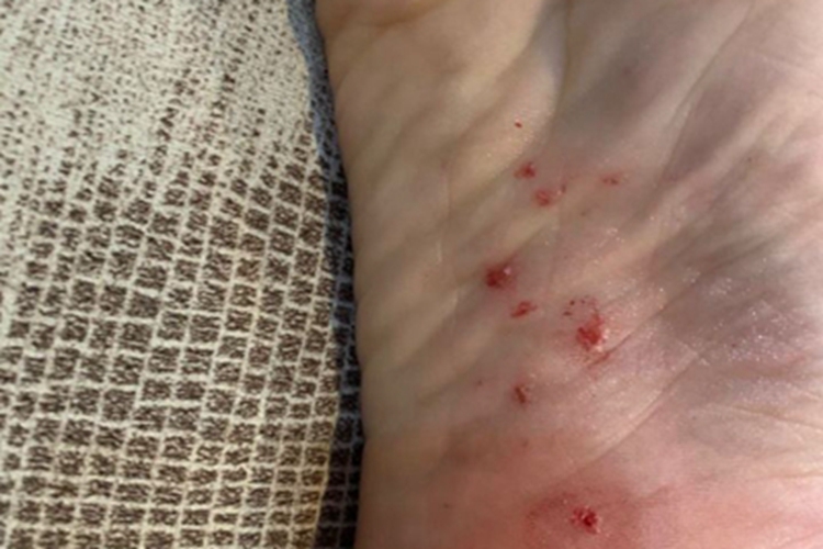 海胆刺伤脚底红点图