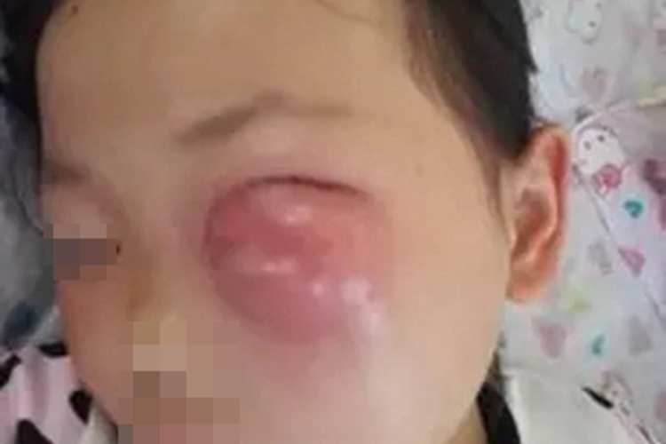 眶蜂窝织炎眼周症状图 眶蜂窝织炎眼周症状图