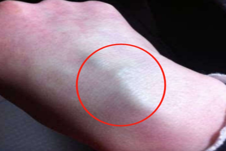 结节性结核性静脉炎手背疙瘩图 结节性结核性静脉炎手背疙瘩图