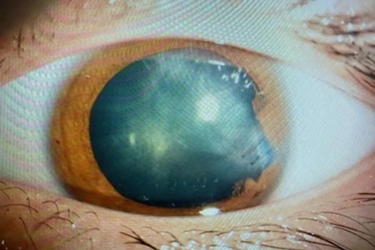 电击伤所致白内障眼球混浊图