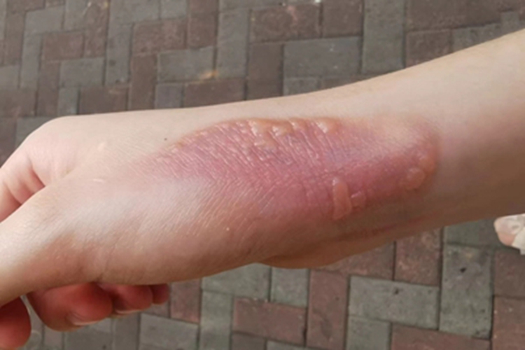 二度烫伤手腕处有水疱图 二度烫伤手腕处有水疱图